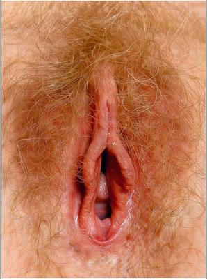 Hairy cunts in hyper resolution II